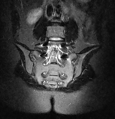 Sacroiliac joint coronal view MRI scan
